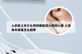 人的身上长什么样的癣能招人呢招人呢 人身体长癣是怎么回事