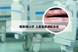 银屑病10岁 儿童银屑病能自愈