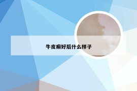 牛皮癣好后什么样子