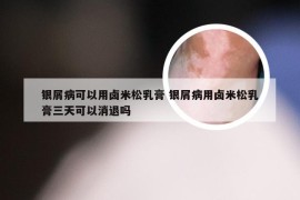 银屑病可以用卤米松乳膏 银屑病用卤米松乳膏三天可以消退吗