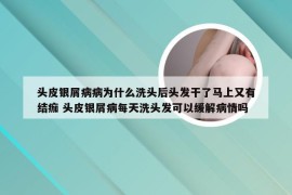 头皮银屑病病为什么洗头后头发干了马上又有结痂 头皮银屑病每天洗头发可以缓解病情吗