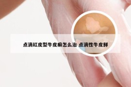 点滴红皮型牛皮癣怎么治 点滴性牛皮鲜