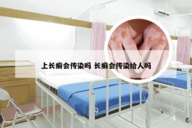 上长癣会传染吗 长癣会传染给人吗