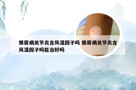 银屑病关节炎含风湿因子吗 银屑病关节炎含风湿因子吗能治好吗