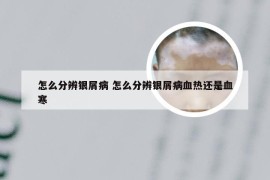 怎么分辨银屑病 怎么分辨银屑病血热还是血寒