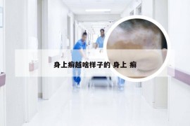 身上癣越啥样子的 身上 癣