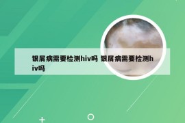 银屑病需要检测hiv吗 银屑病需要检测hiv吗