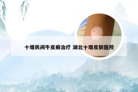 十堰民间牛皮癣治疗 湖北十堰皮肤医院