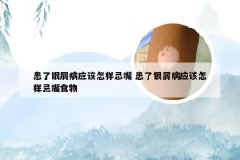 患了银屑病应该怎样忌嘴 患了银屑病应该怎样忌嘴食物