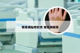 银屑病贴吧积壳 银屑病银屑