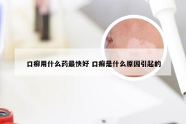 口癣用什么药最快好 口癣是什么原因引起的