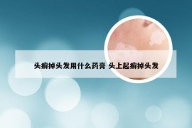 头癣掉头发用什么药膏 头上起癣掉头发