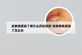 皮肤挠感染了用什么药比较好 皮肤痒抓感染了怎么办