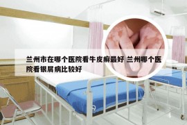 兰州市在哪个医院看牛皮癣最好 兰州哪个医院看银屑病比较好