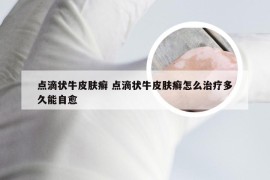 点滴状牛皮肤癣 点滴状牛皮肤癣怎么治疗多久能自愈