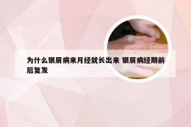 为什么银屑病来月经就长出来 银屑病经期前后复发