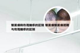 银屑病和玖瑰糠疹的区别 银屑病银屑病初期与玫瑰糠疹的区别