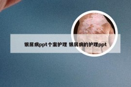 银屑病ppt个案护理 银屑病的护理ppt