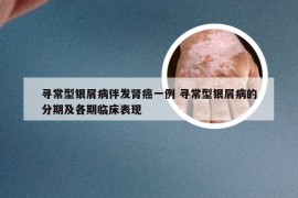 寻常型银屑病伴发肾癌一例 寻常型银屑病的分期及各期临床表现