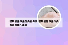 银屑病是不是体内有毒素 银屑病是不是体内有毒素排不出来