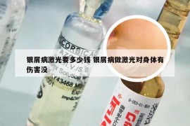 银屑病激光要多少钱 银屑病做激光对身体有伤害没