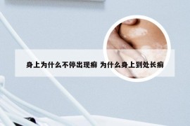 身上为什么不停出现癣 为什么身上到处长癣