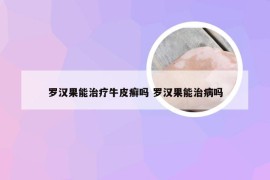 罗汉果能治疗牛皮癣吗 罗汉果能治病吗