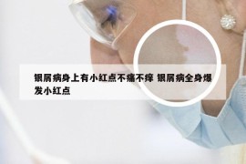 银屑病身上有小红点不痛不痒 银屑病全身爆发小红点