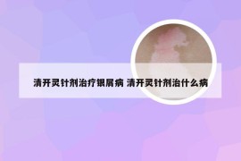 清开灵针剂治疗银屑病 清开灵针剂治什么病