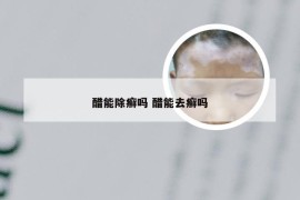 醋能除癣吗 醋能去癣吗