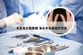 手足角化银屑病 角化手足癣治疗方法