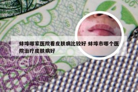 蚌埠哪家医院看皮肤病比较好 蚌埠市哪个医院治疗皮肤病好