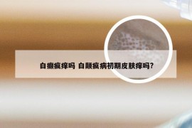 白癫疯痒吗 白颠疯病初期皮肤痒吗?