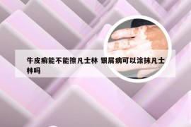 牛皮癣能不能擦凡士林 银屑病可以涂抹凡士林吗