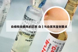 白癍和白癜风的区别 白疕与白屑风鉴别要点