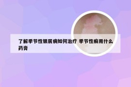 了解季节性银屑病如何治疗 季节性癣用什么药膏