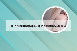 身上长白斑会传染吗 身上长白斑会不会传染