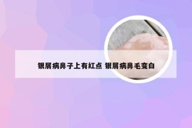 银屑病鼻子上有红点 银屑病鼻毛变白