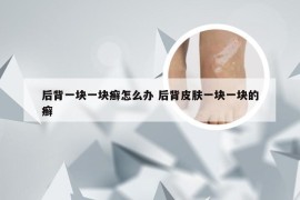 后背一块一块癣怎么办 后背皮肤一块一块的癣