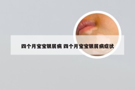 四个月宝宝银屑病 四个月宝宝银屑病症状