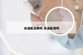 水油能治癣吗 水油能用吗