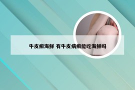 牛皮癣海鲜 有牛皮病癣能吃海鲜吗