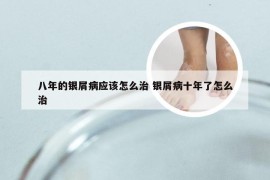 八年的银屑病应该怎么治 银屑病十年了怎么治