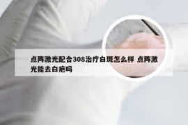 点阵激光配合308治疗白斑怎么样 点阵激光能去白疤吗