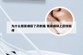 为什么银屑病搽了药刺痛 银屑病抹上药特别疼