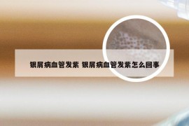 银屑病血管发紫 银屑病血管发紫怎么回事