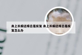 身上长癣还痒总是反复 身上长癣还痒总是反复怎么办