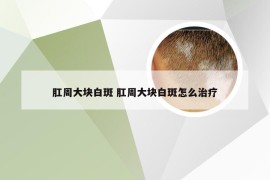 肛周大块白斑 肛周大块白斑怎么治疗