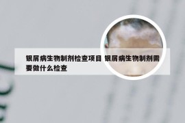 银屑病生物制剂检查项目 银屑病生物制剂需要做什么检查