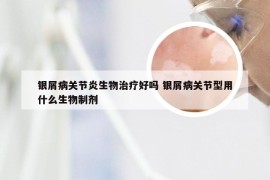 银屑病关节炎生物治疗好吗 银屑病关节型用什么生物制剂